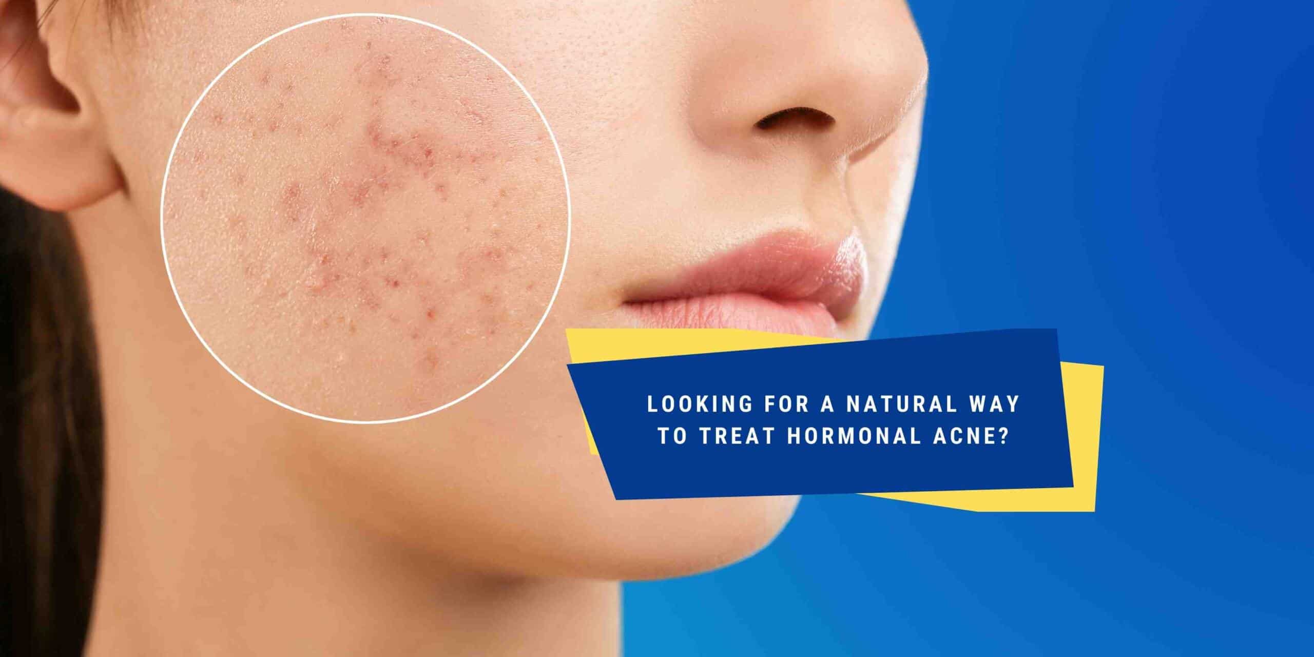 How To Treat Hormonal Acne Natural Methods That Work