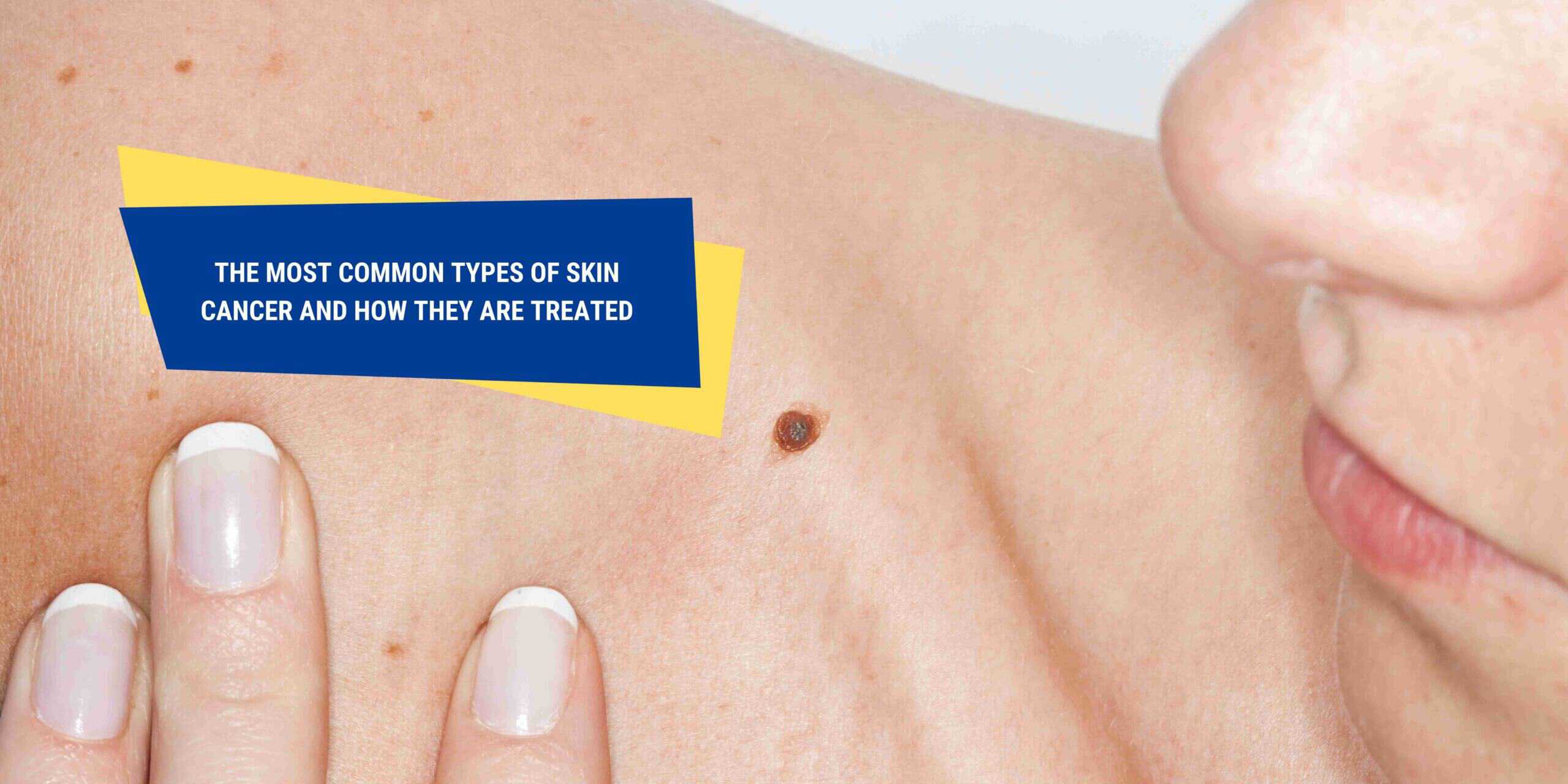 Most Common Types Of Skin Cancer And How They Are Treated